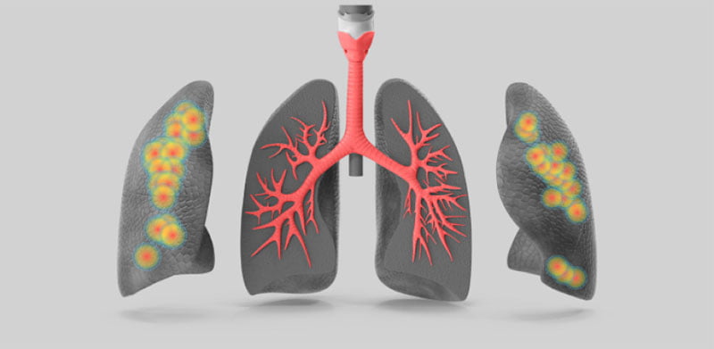 Lungs AI measurement